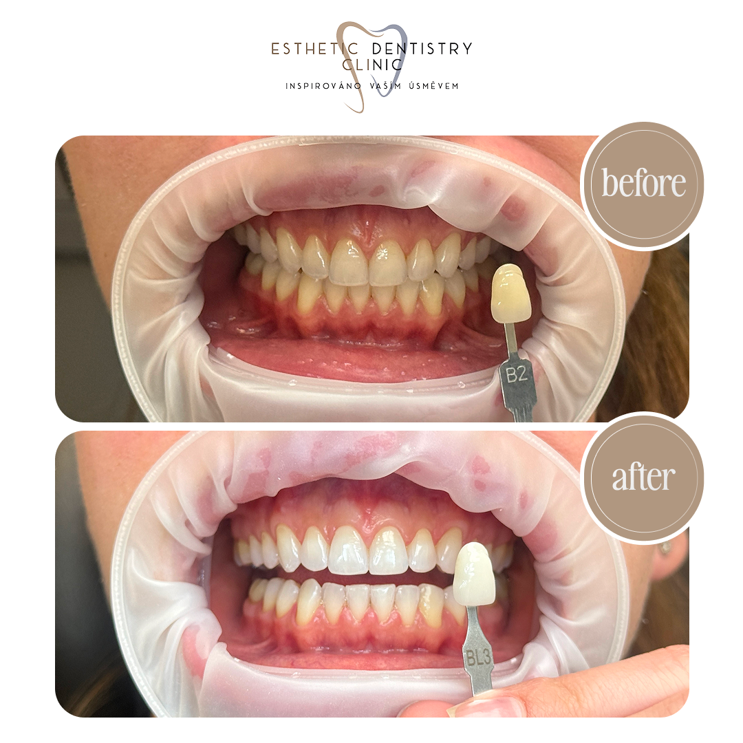 Balíček dentální hygiena + bělení zubů za 2 999 Kč